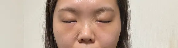 クマ治療 湘南美容クリニック 千葉センシティ院 DAY 6 メイン用