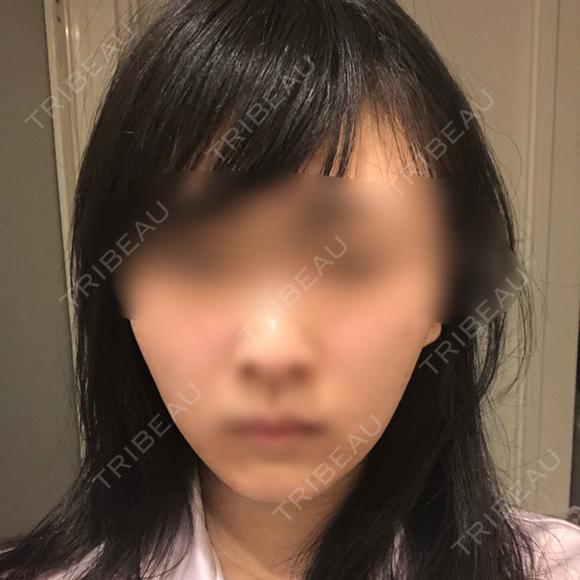 バッカルファット除去 / 脂肪吸引（顔） / ヒアルロン酸注入（鼻） / ボトックス（あご） / 水光注射（ハリ・美肌） / ボトックス（エラ・小顔） / ボトックス（口角） / 白玉点滴・注射 エートップ美容整形外科 AFTER メイン用