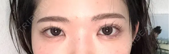 ヒアルロン酸注入（涙袋） PRO CLINIC プロクリニック 銀座院 AFTER メイン用