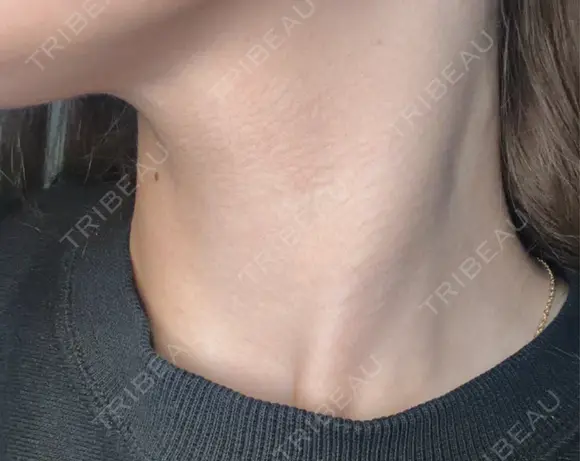 ボトックス（あご） / ボトックス（エラ・小顔） / ボトックス（口角） / ボトックス（眉間） / ボトックス（額） / ボトックス（首） 大美会クリニック 神戸院 DAY 0 メイン用