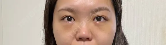 クマ治療 湘南美容クリニック 千葉センシティ院 AFTER メイン用