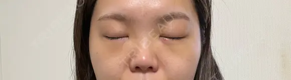 クマ治療 湘南美容クリニック 千葉センシティ院 DAY 7 メイン用