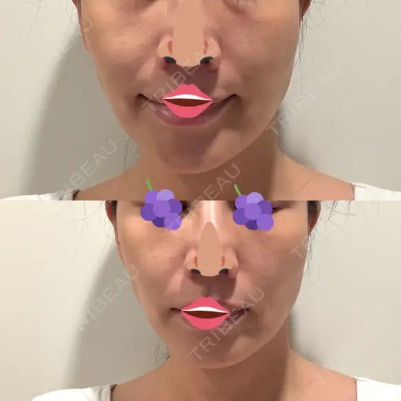 オリジオ PRISM Beauty Clinic 新宿院 DAY 4 メイン用