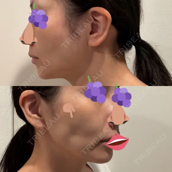 オリジオ PRISM Beauty Clinic 新宿院 DAY 4 メイン用