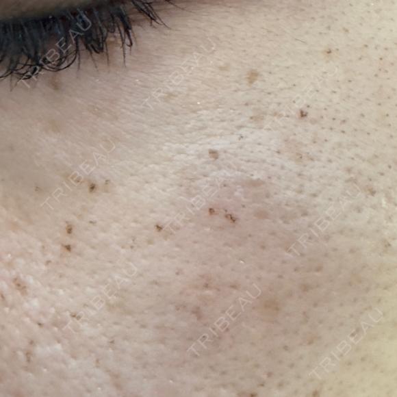 その他（肌） / 光治療（フォトフェイシャルなど） / ルメッカ BITO BEAUTY CLINIC DAY 2 メイン用