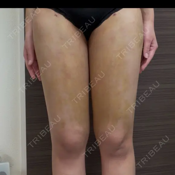 脂肪吸引（脚） / 豊胸（脂肪注入） 湘南美容クリニック Regno 銀座院 DAY 7 メイン用