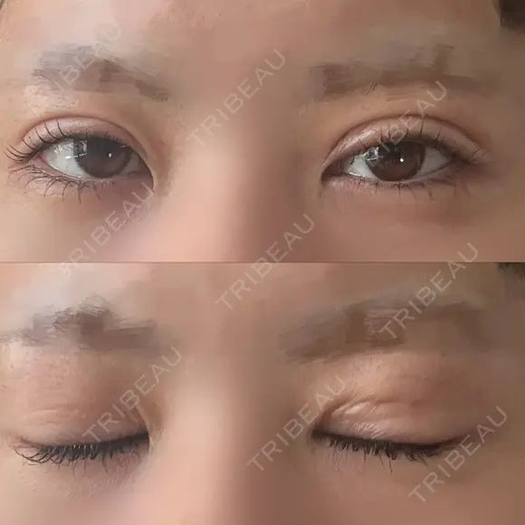 二重埋没 形成外科と美容外科のクリニック池袋 DAY 8 メイン用