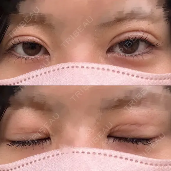 二重埋没 形成外科と美容外科のクリニック池袋 DAY 10 メイン用