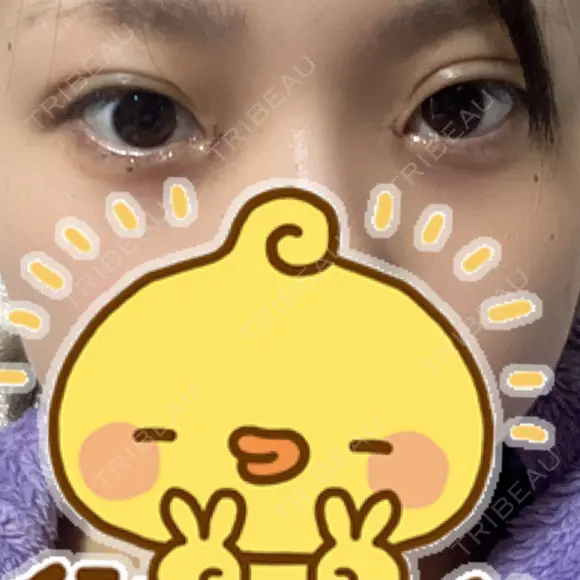 目頭切開 新宿美容外科ネビュラクリニック DAY 2 メイン用