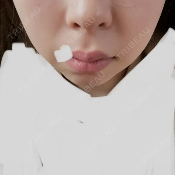 ハイフ（顔） 表参道メディカルクリニック 名古屋院 AFTER メイン用