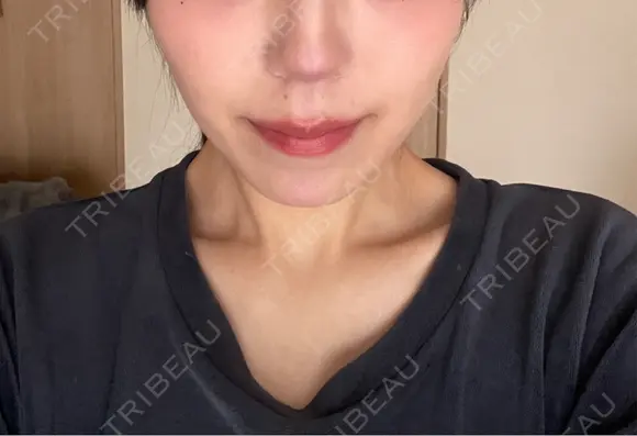 インモード TUNE CLINIC【チューンクリニック】 DAY 7 メイン用