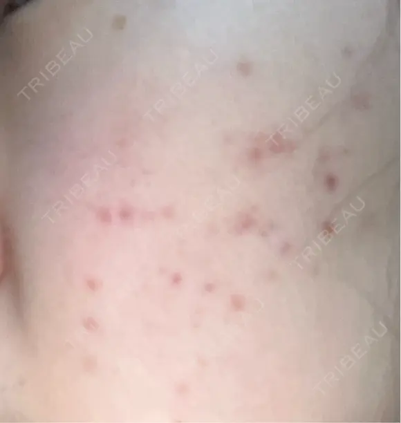 その他（肌） / ポテンツァ ルラ美容クリニック 郡山院 DAY 3 メイン用