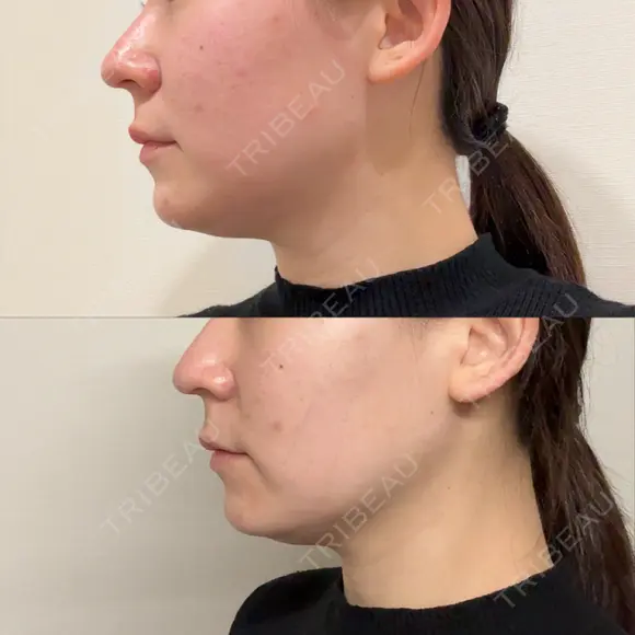 糸リフト ガーデンクリニック 船橋院 DAY 0 メイン用