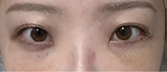 クマ治療 / 下まぶたたるみ取り / 下まぶたの脂肪取り / ヒアルロン酸注入（目の下） / スネコス 新宿美容外科ネビュラクリニック DAY 5 メイン用