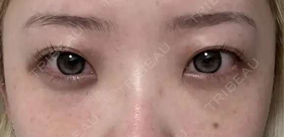 クマ治療 / 下まぶたたるみ取り / 下まぶたの脂肪取り / ヒアルロン酸注入（目の下） / スネコス 新宿美容外科ネビュラクリニック AFTER メイン用