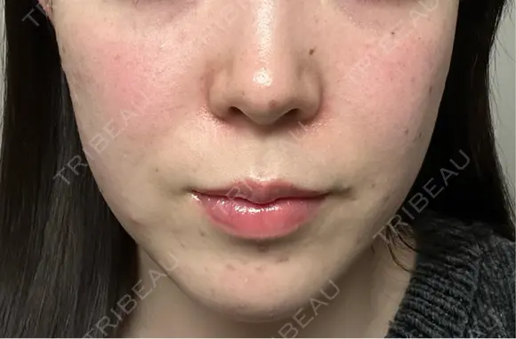 ピーリング（ニキビ・毛穴） / ピーリング（ハリ・ツヤ） / ルメッカ ハナビューティークリニック DAY 1 メイン用