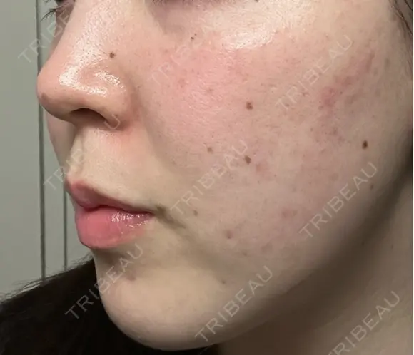 ピーリング（ニキビ・毛穴） / ピーリング（ハリ・ツヤ） / ルメッカ ハナビューティークリニック DAY 1 メイン用