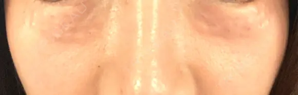 プラセンタ注射 / 肌育注射（ジュベルックなど） 千葉美容外科アイビークリニック DAY 0 メイン用