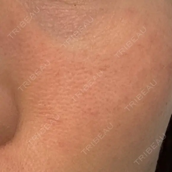 美肌レーザー LEX BEAUTY CLINIC DAY 3 メイン用