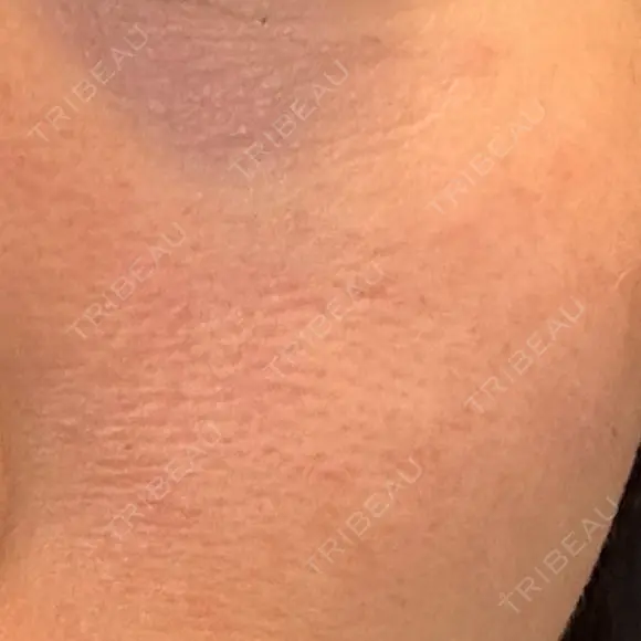 美肌レーザー LEX BEAUTY CLINIC DAY 4 メイン用