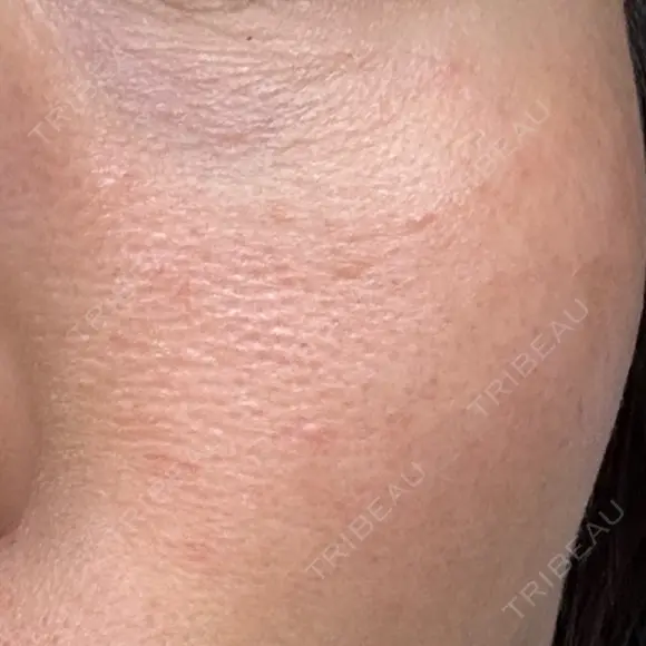 美肌レーザー LEX BEAUTY CLINIC DAY 5 メイン用