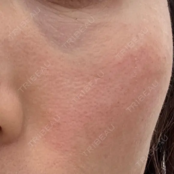 美肌レーザー LEX BEAUTY CLINIC DAY 6 メイン用