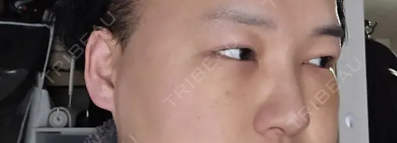 クマ治療 / 下まぶたたるみ取り 湘南美容クリニック 千葉センシティ院 DAY 5 メイン用