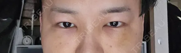 クマ治療 / 下まぶたたるみ取り 湘南美容クリニック 千葉センシティ院 DAY 5 メイン用