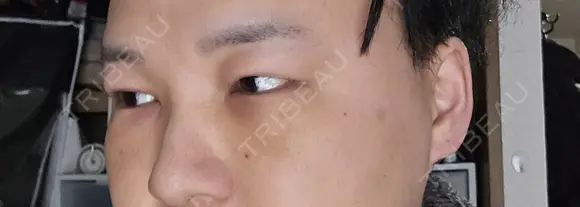 クマ治療 / 下まぶたたるみ取り 湘南美容クリニック 千葉センシティ院 DAY 5 メイン用