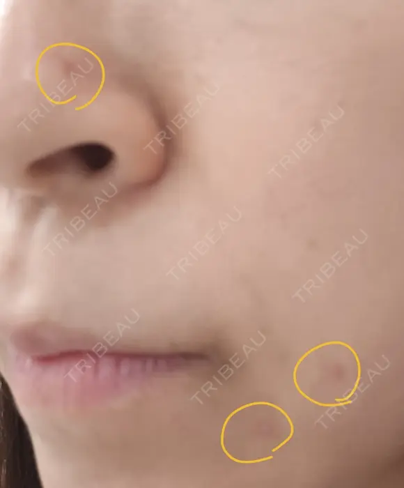 ほくろ・いぼ切除（肌） CLINIC W DAY 27 メイン用