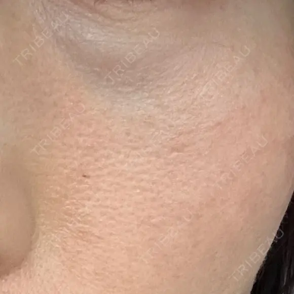 美肌レーザー LEX BEAUTY CLINIC DAY 7 メイン用