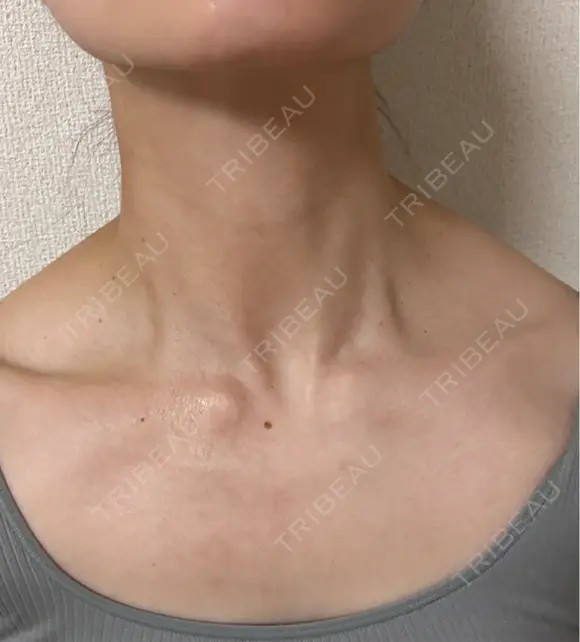 ボトックス（エラ・小顔） DMTC CLINIC 日本橋院 AFTER メイン用