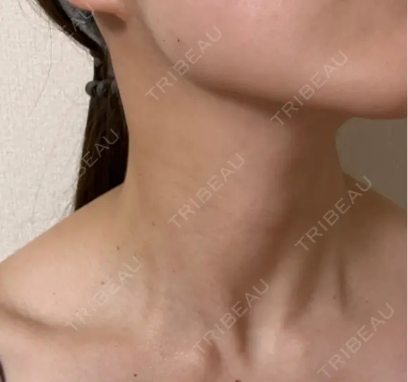 ボトックス（エラ・小顔） DMTC CLINIC 日本橋院 DAY 0 メイン用