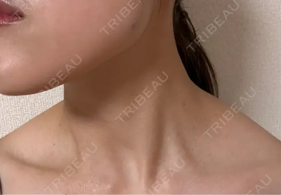 ボトックス（エラ・小顔） DMTC CLINIC 日本橋院 DAY 0 メイン用