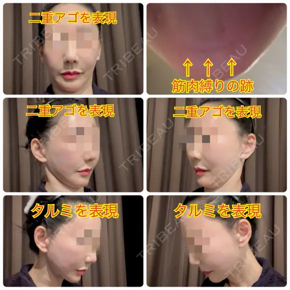 バッカルファット除去 / その他（輪郭） / 切開リフト / メーラーファット除去 / ジョールファット除去 / あご下筋肉縛り / ネックリフト / ヒアルロン酸注入（頬） / ヒアルロン酸注入（首） タシピウム整形外科 DAY 365 メイン用