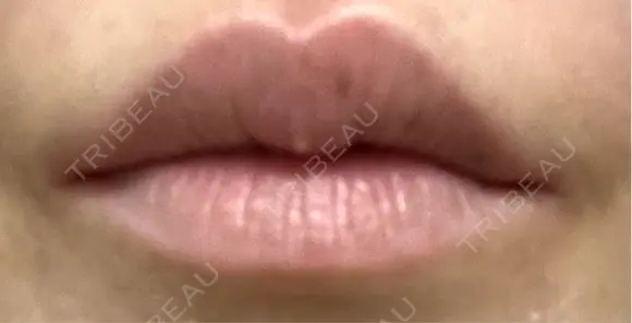 ヒアルロン酸注入（涙袋） / ヒアルロン酸注入（唇） / ボトックス（肩） / ボトックス（首） / シミ取りレーザー ルヴィクリニック イオンドーム前院 AFTER メイン用