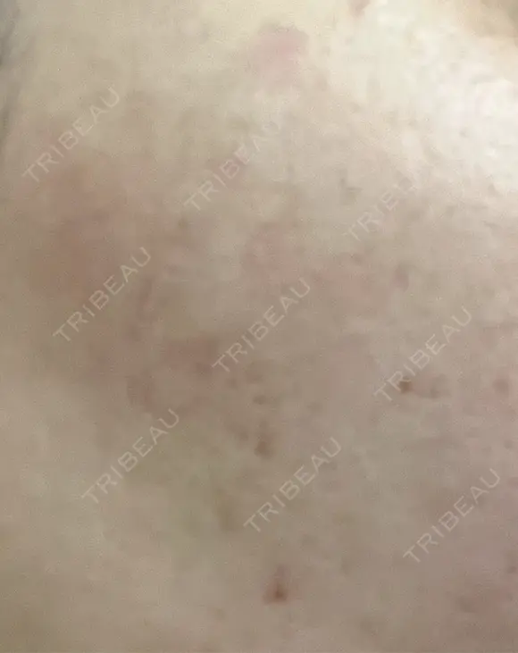 ヒアルロン酸注入（涙袋） / ヒアルロン酸注入（唇） / ボトックス（肩） / ボトックス（首） / シミ取りレーザー ルヴィクリニック イオンドーム前院 DAY 18 メイン用