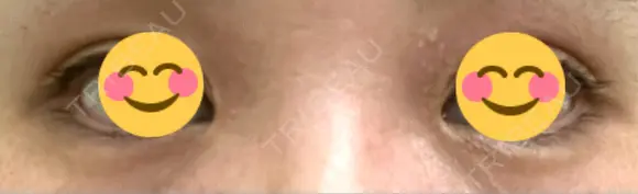 ヒアルロン酸注入（涙袋） / ヒアルロン酸注入（唇） / ボトックス（肩） / ボトックス（首） / シミ取りレーザー ルヴィクリニック イオンドーム前院 DAY 18 メイン用