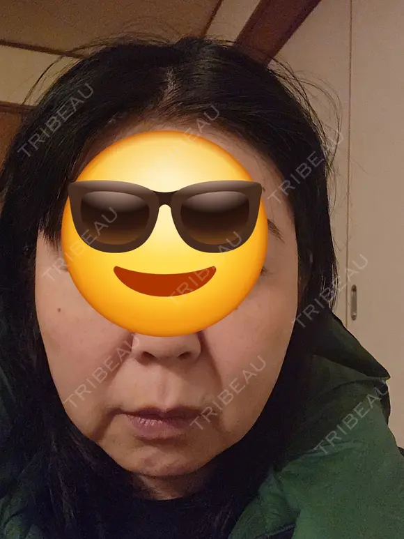 デンシティ 湘南美容クリニック 松戸院 AFTER メイン用