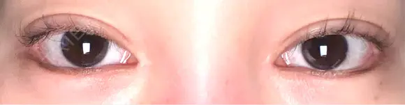 目尻切開 / タレ目形成・グラマラスライン（埋没） LOUIS CLINIC 二子玉川院【ルイクリニック】 DAY 16 メイン用