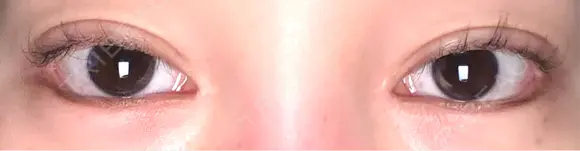 目尻切開 / タレ目形成・グラマラスライン（埋没） LOUIS CLINIC 二子玉川院【ルイクリニック】 AFTER メイン用