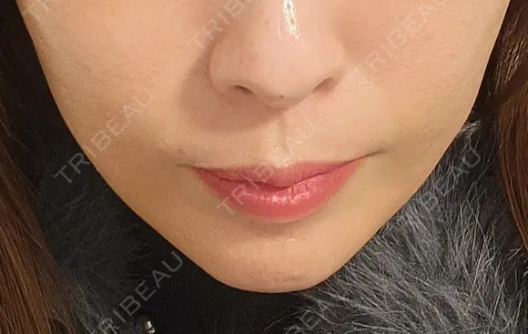 ボトックス（口角） eクリニック 岡山院 DAY 7 メイン用