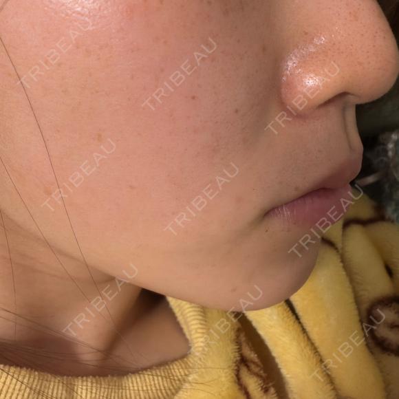 エレクトロポレーション BITO BEAUTY CLINIC DAY 0 メイン用