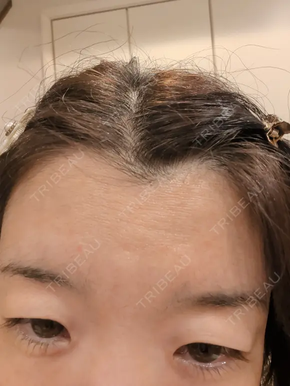 再生医療 A CLINIC（エークリニック） 新宿院 AFTER メイン用