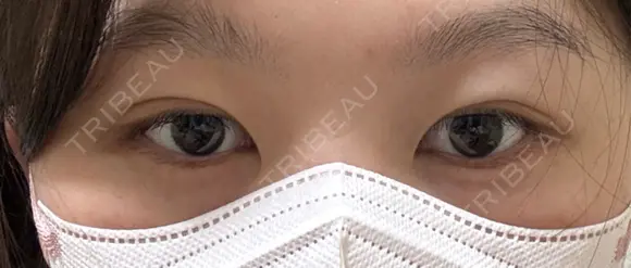 二重埋没 湘南美容クリニック 千葉センシティ院 AFTER メイン用