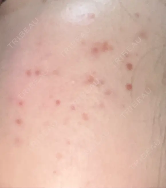 その他（肌） / ポテンツァ ルラ美容クリニック 郡山院 DAY 4 メイン用