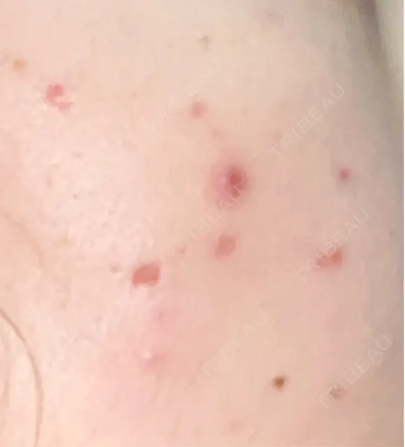 その他（肌） / ポテンツァ ルラ美容クリニック 郡山院 DAY 4 メイン用