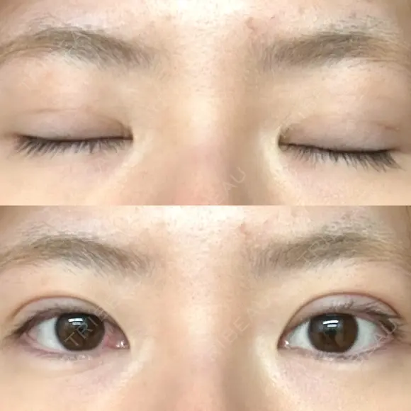 二重埋没 / 上まぶたの脂肪取り アリエル美容クリニック 郡山院 DAY 49 メイン用