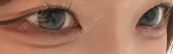 二重埋没 恵聖会クリニック 京橋院 AFTER メイン用