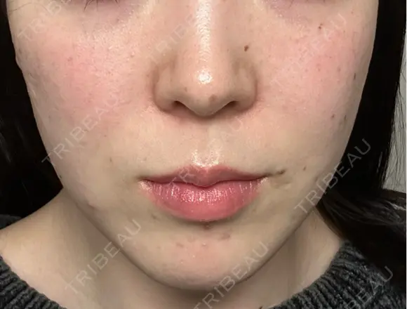 ピーリング（ニキビ・毛穴） / ピーリング（ハリ・ツヤ） / ルメッカ ハナビューティークリニック DAY 2 メイン用